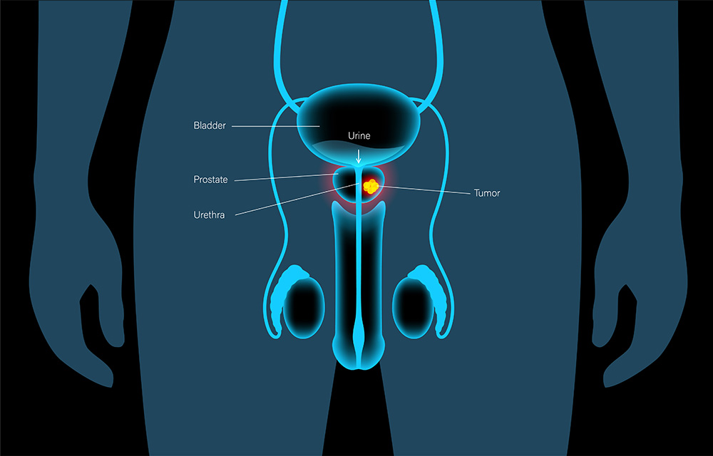What is Rezūm minimally invasive steam injection therapy and how it treats BPH
